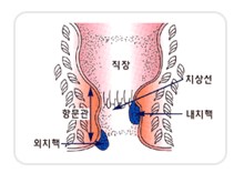 치핵그림